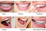 9 lucruri pe care trebuie sa le stii inainte de a-ti pune aparat dentar