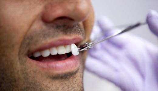 Fatetele dentare – cum le ingrijim?