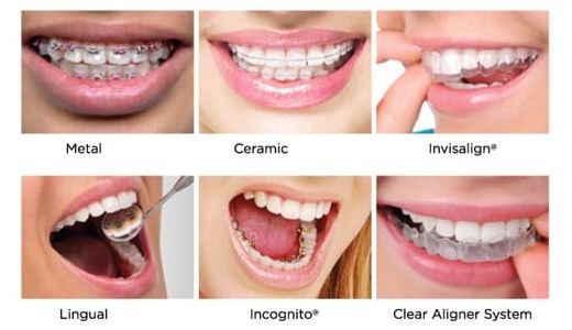 9 lucruri pe care trebuie sa le stii inainte de a-ti pune aparat dentar
